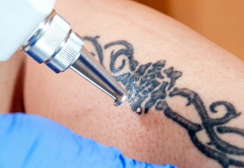 Fjernelse af tatoveringer: findes der alternativer til laser, og hvorfor er det netop laser, der er den gyldne standard?
